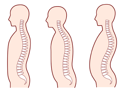 姿勢と腰痛の関係